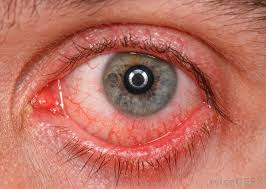 High Blood Pressure Eye Diseases